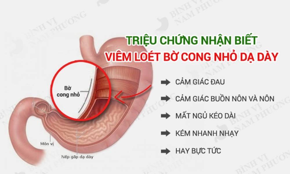VIÊM LOÉT BỜ CONG NHỎ DẠ DÀY RẤT NGUY HIỂM